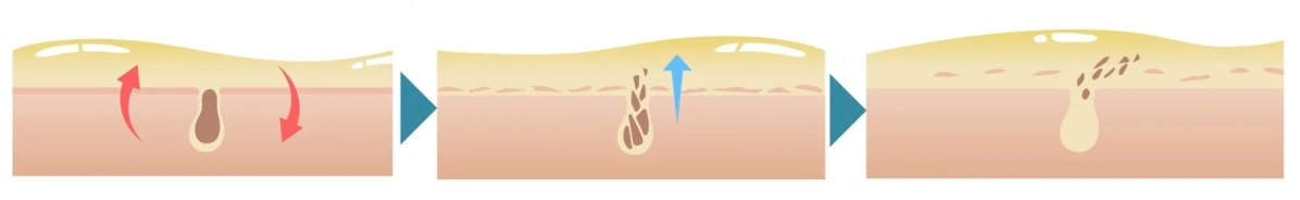 毛穴ディープクレンジングの概念図