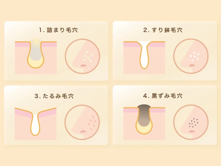 4種類の毛穴トラブル