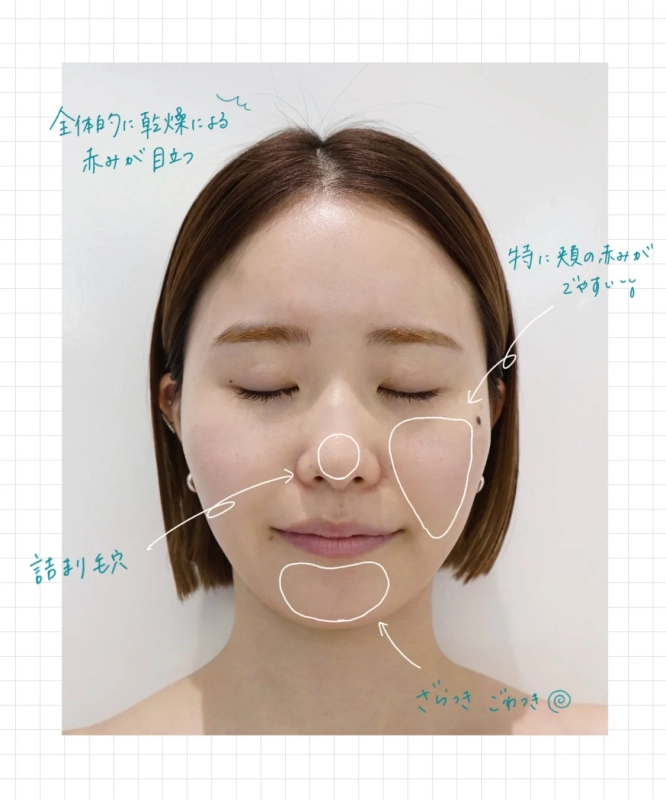 スタッフKの肌悩み