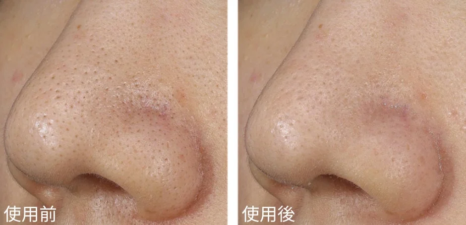 毛穴のビフォーアフター