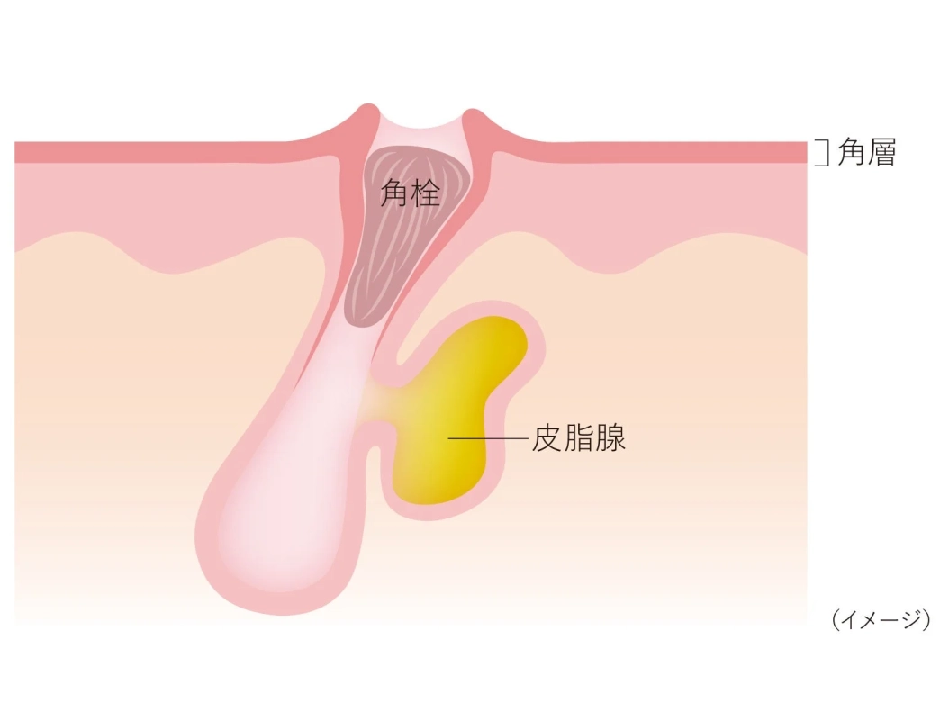 毛穴と角栓の断面図