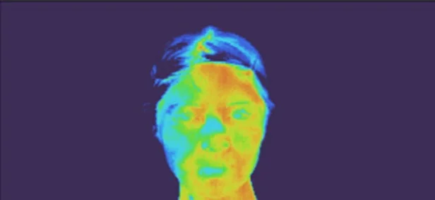 ラジオ波使用後の顔のサーモグラフィー画像