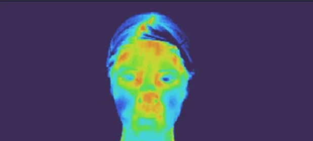 ラジオ波使用後の顔のサーモグラフィー画像
