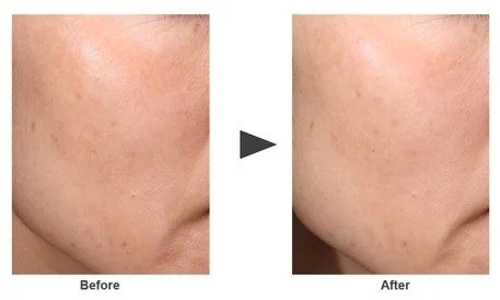 肌のBefore/After