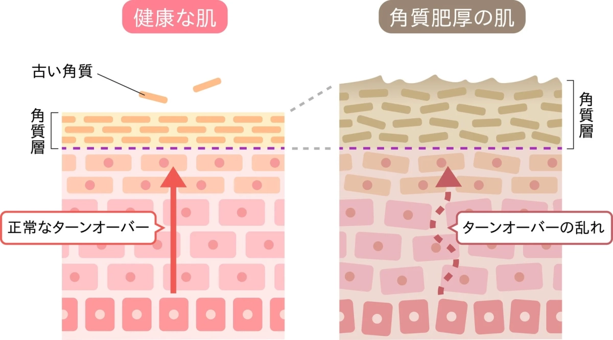健康な肌と角質肥厚の肌の比較図